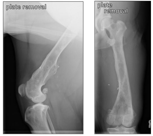 The fracture site is completely healed. The repair is stable enough for the plate to be removed. New bone has grown in and around the fracture site and union has been achieved.