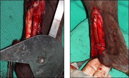 VTS Allograft Achilles Tendon Surgery Brown Pulled Tight