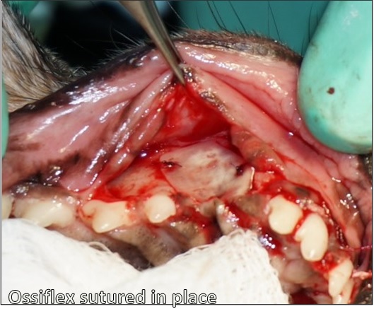 VTS Allograft Bone Membrane Oronasal Fistula Dentistry Sutured in Place 2