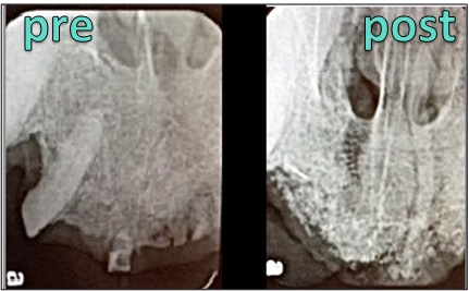 VTS Xenograft Orthomix Dental Extraction Radiograph Maxilla