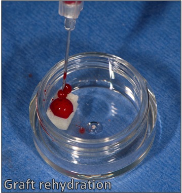 VTS Allograft Mini Block Guided Tissue Regeneration Dental Graft Rehydration