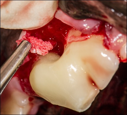 VTS Allograft Mini Block Guided Tissue Regeneration Dental Mini Block Slice