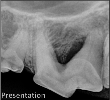 VTS Allograft Mini Block Guided Tissue Regeneration Dental Presentation Radiograph
