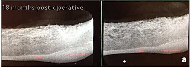 VTS Allograft Bone Putty Fusion Xpress Periodontal Disease Healed 18 mo rads