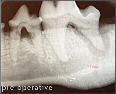 VTS Allograft Bone Putty Fusion Xpress Periodontal Disease Healed pre op