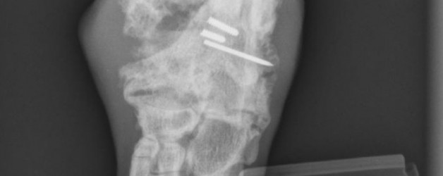 Laborador Rescue with Tarsal Bone Loss